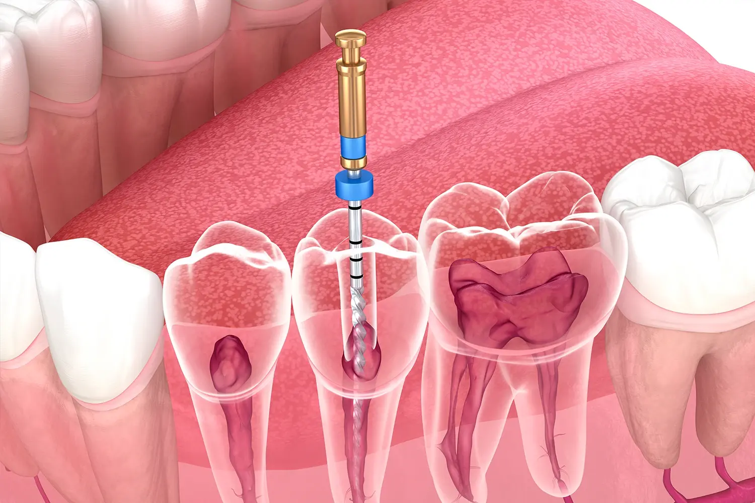 Endodontische WurzelkanalBehandlung. Medizinisch genaue Zahn 3D-Illustration.